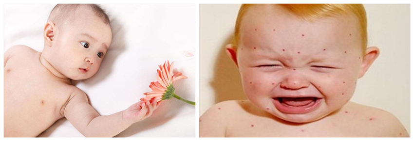 兒童濕疹反反復(fù)復(fù)，您有在家安裝家用除濕產(chǎn)品嗎？